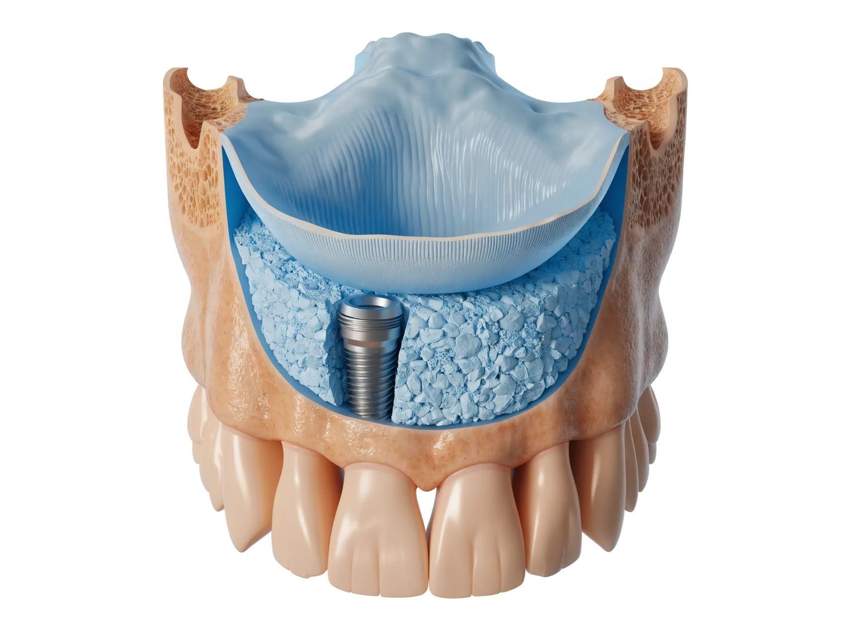 Dental treatment planning illustration for patients researching care in Turkey