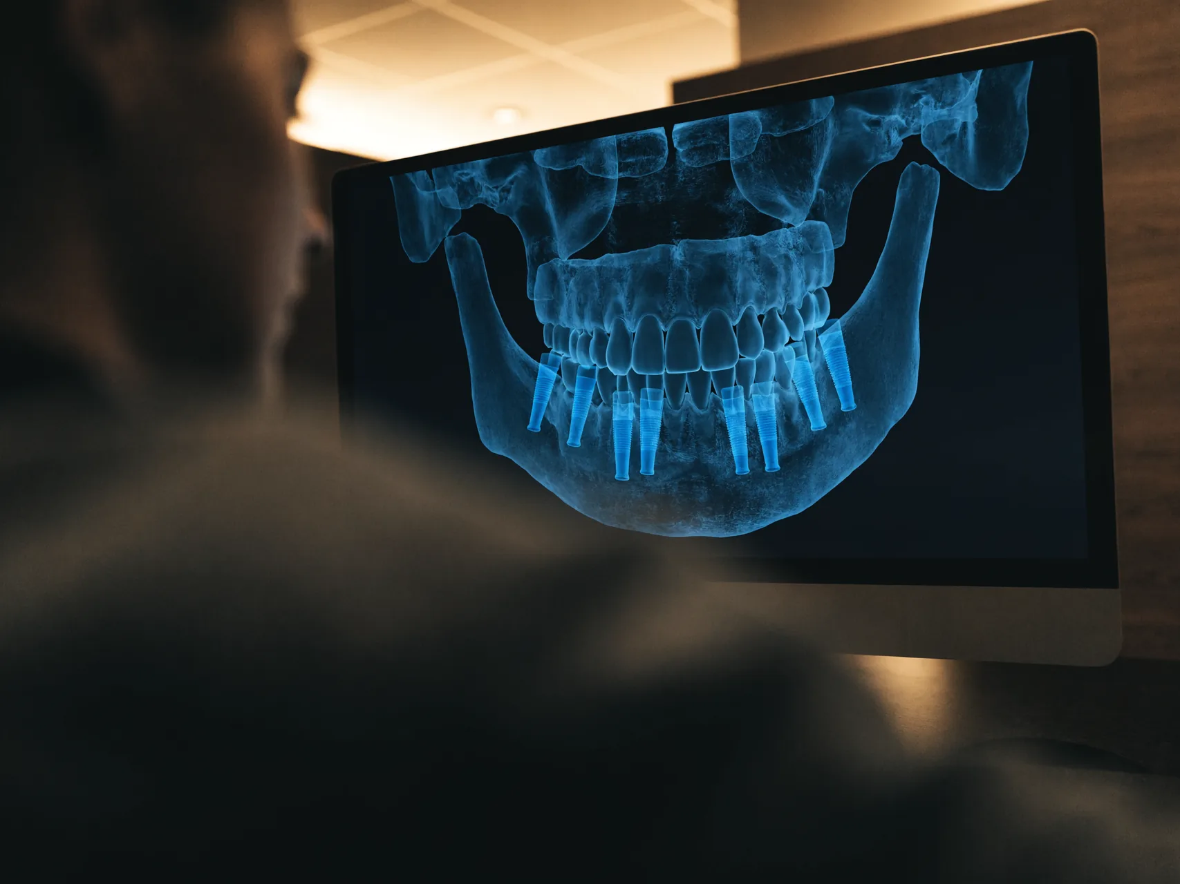 Three-dimensional CBCT reconstruction of a jaw on a planning monitor with implant positions marked