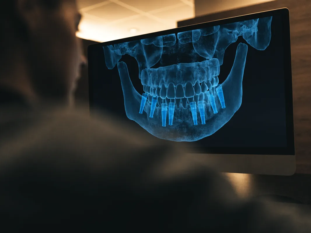 إعادة بناء ثلاثية الأبعاد لصورة CBCT للفك على شاشة التخطيط مع تحديد مواضع الزرعات