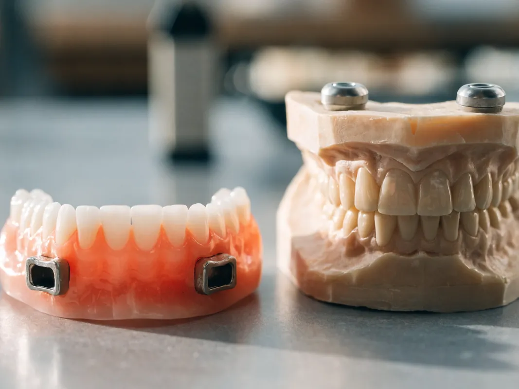 Implant-supported overdenture beside a jaw model fitted with locator attachments