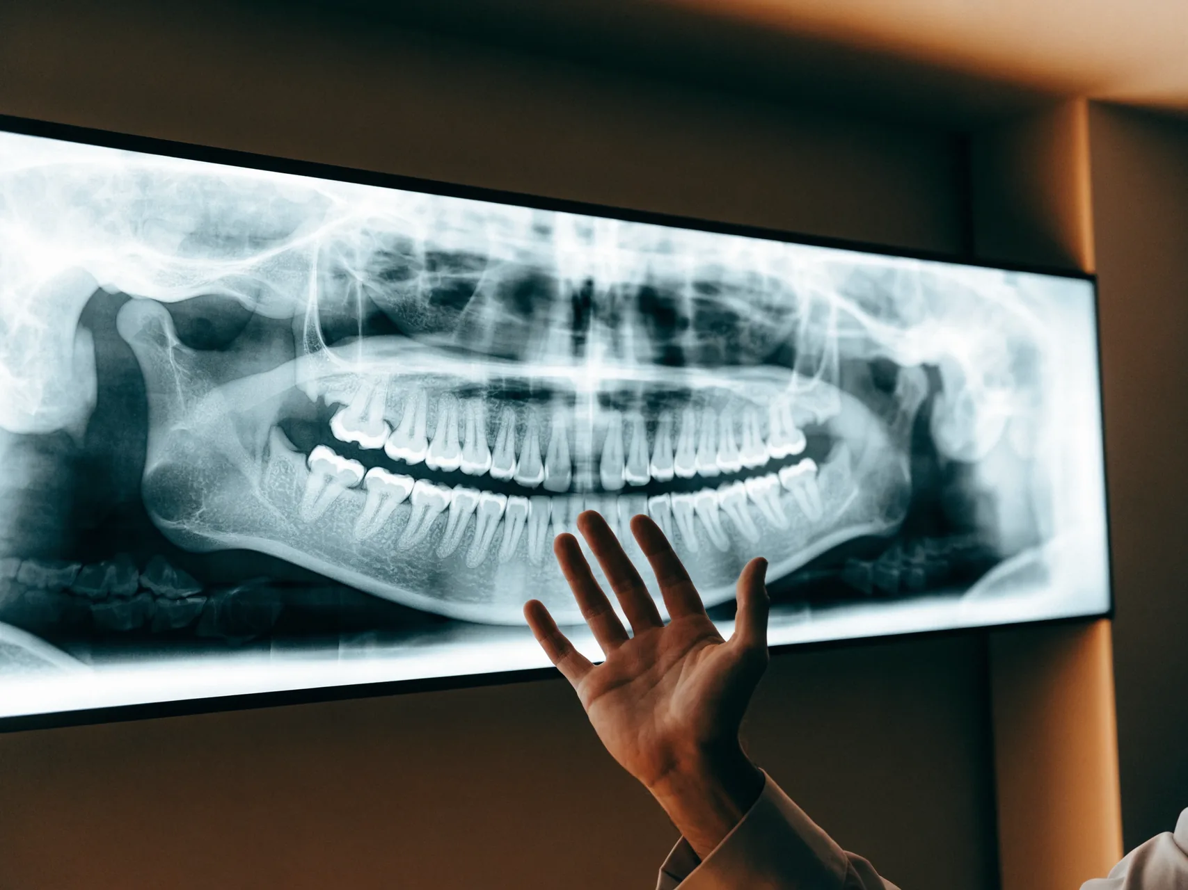 Panoramic dental radiograph on a viewing screen showing both jaws and the wisdom teeth